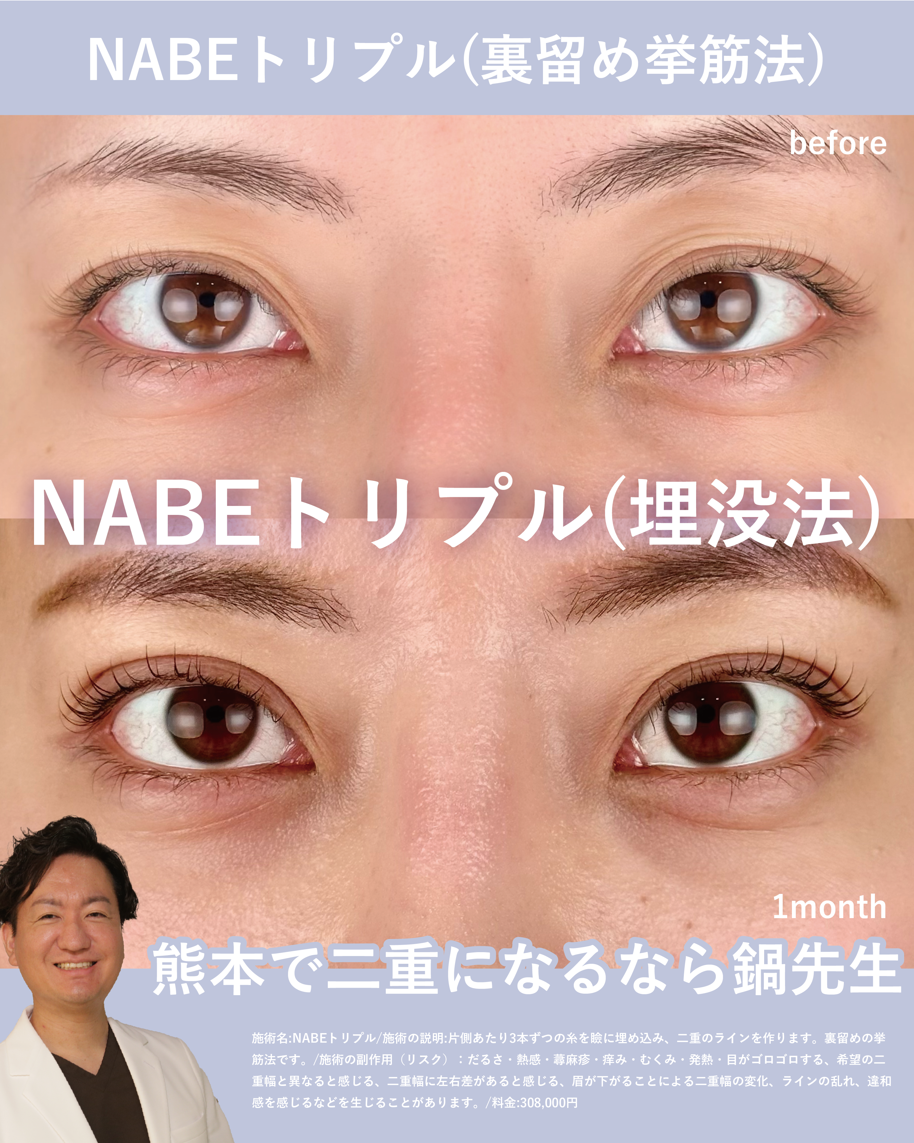 NABEトリプル(埋没法二重術)のメイン画像