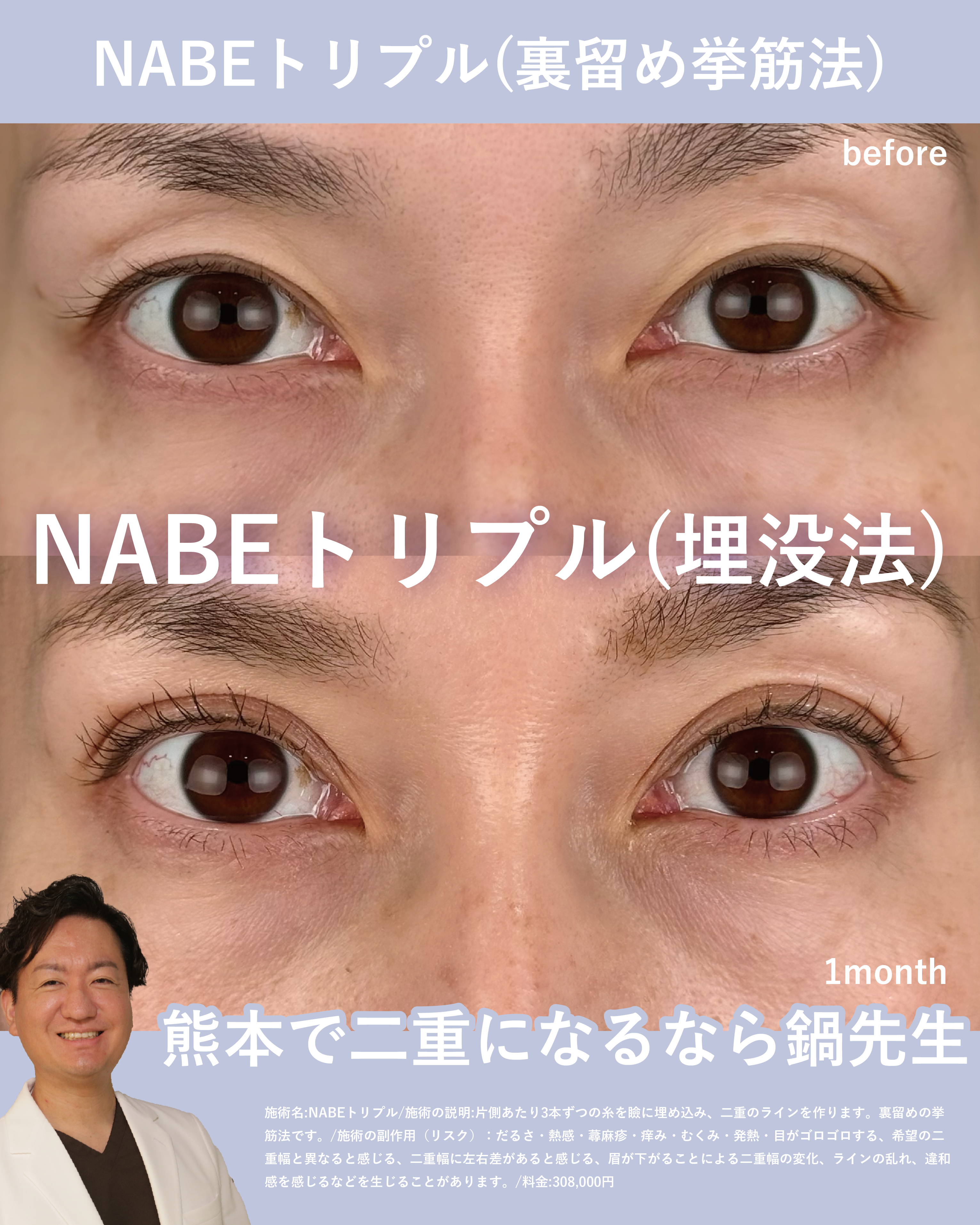 NABEトリプル(埋没法二重術)のメイン画像