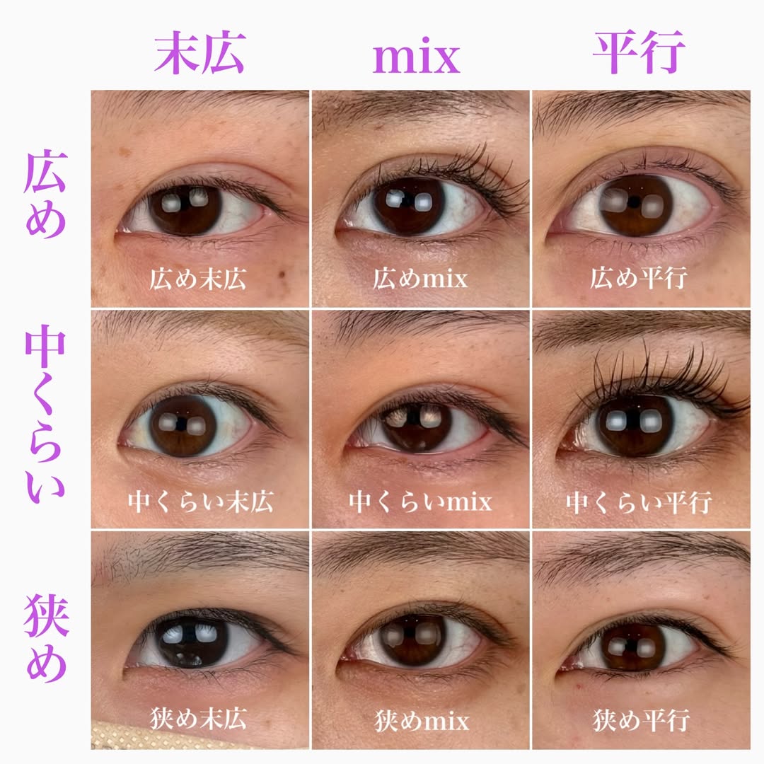 二重整形埋没法瞼の種類