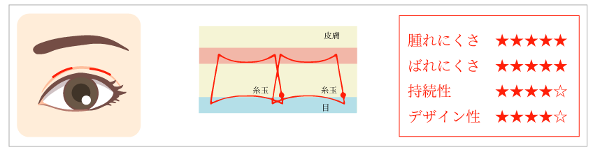 埋没法二重術のメイン画像