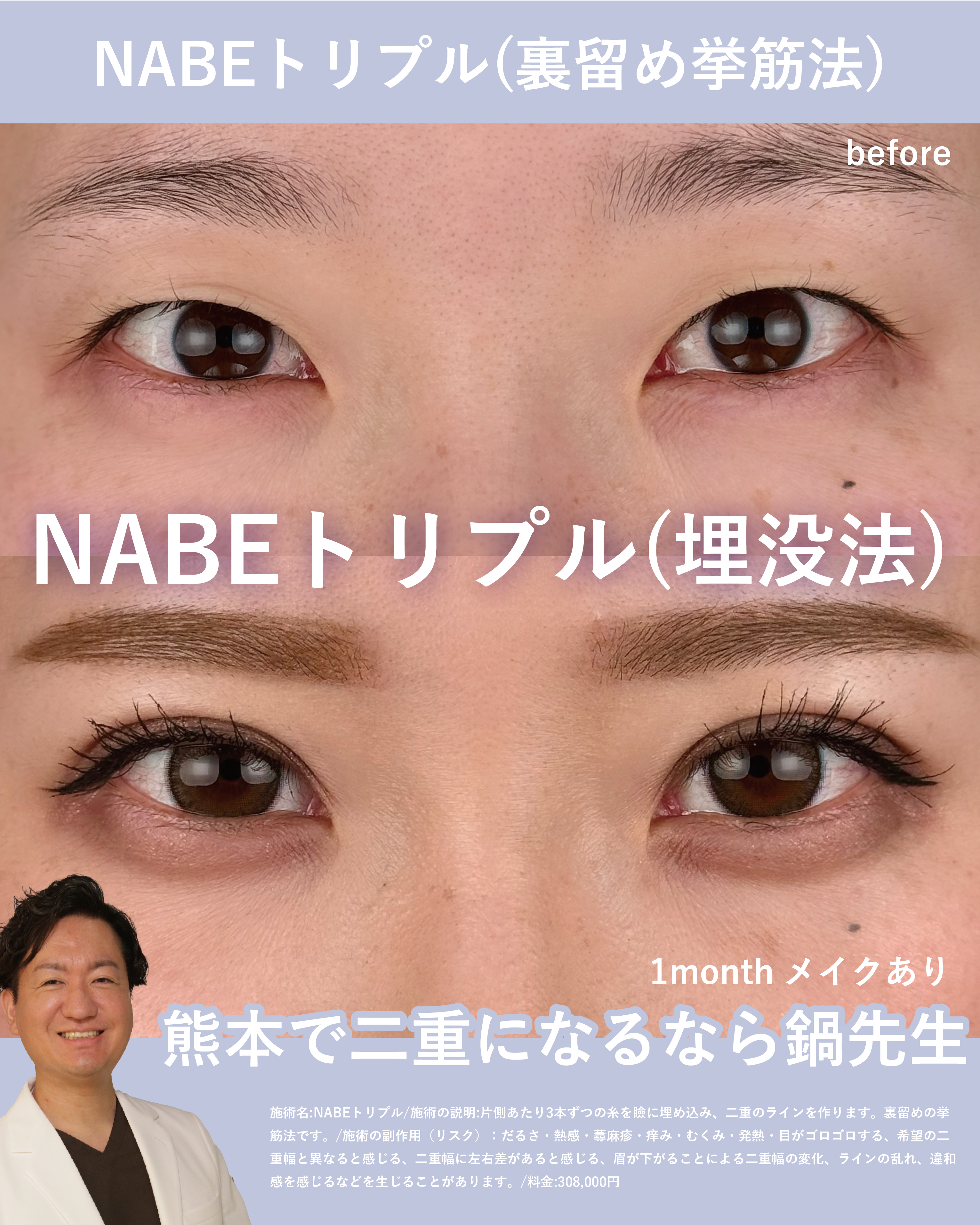 NABEトリプル(埋没法二重術)のメイン画像