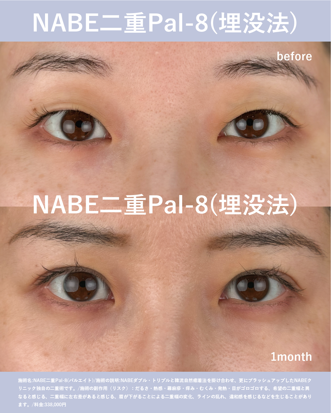 NABE二重術 Pal-8(パルエイト)のメイン画像