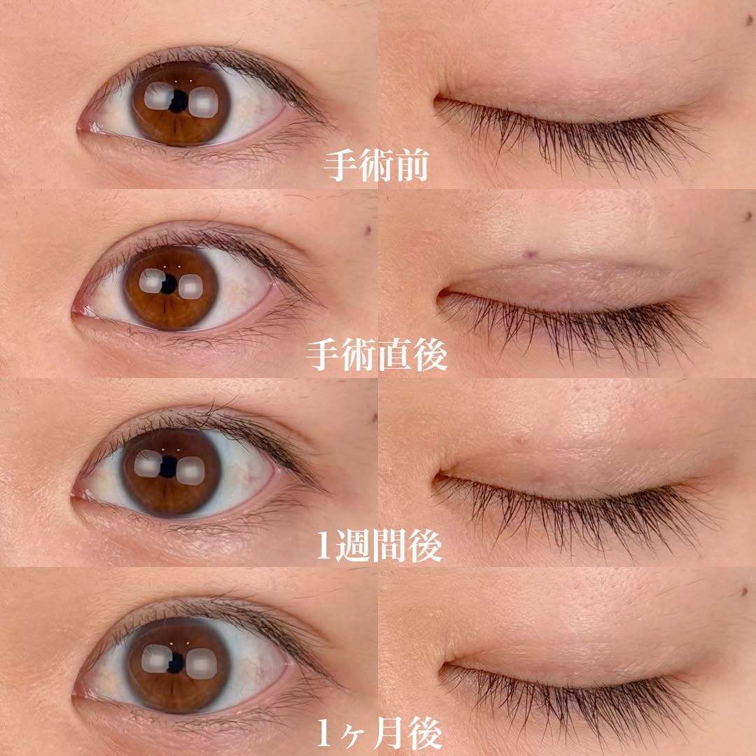 二重整形埋没法の経過症例の画像