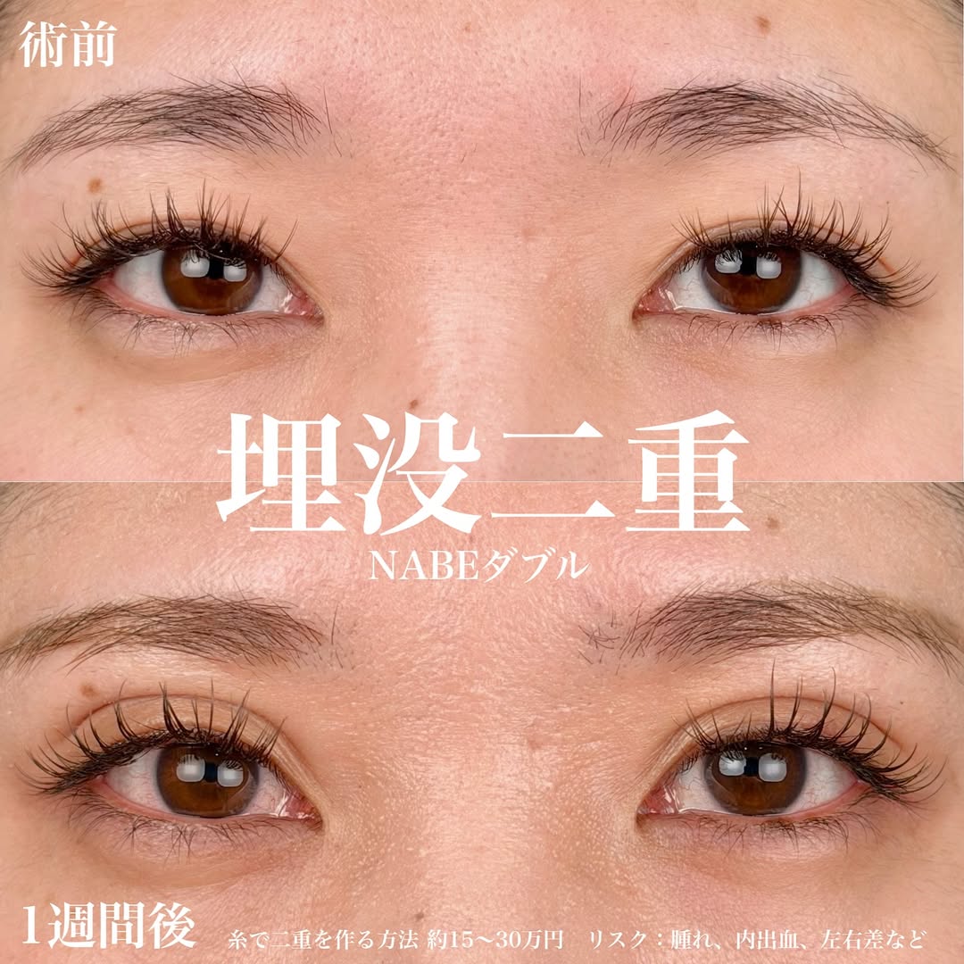 二重整形埋没法 NABEダブル