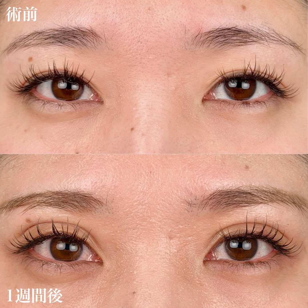 二重整形埋没法 NABEダブルのギャラリー画像