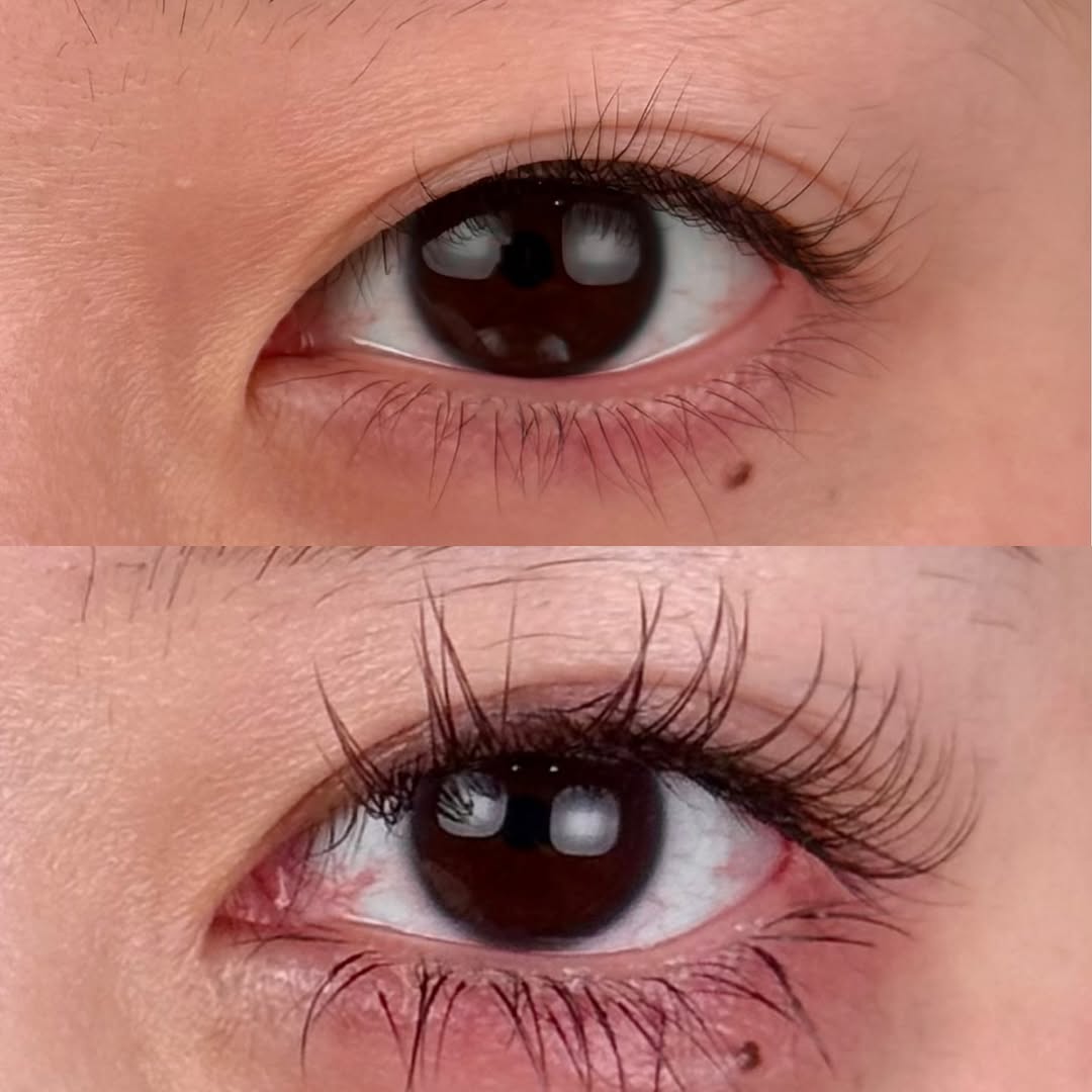 目元のフル整形 -目頭目尻切開,二重埋没,たれ目-のギャラリー画像