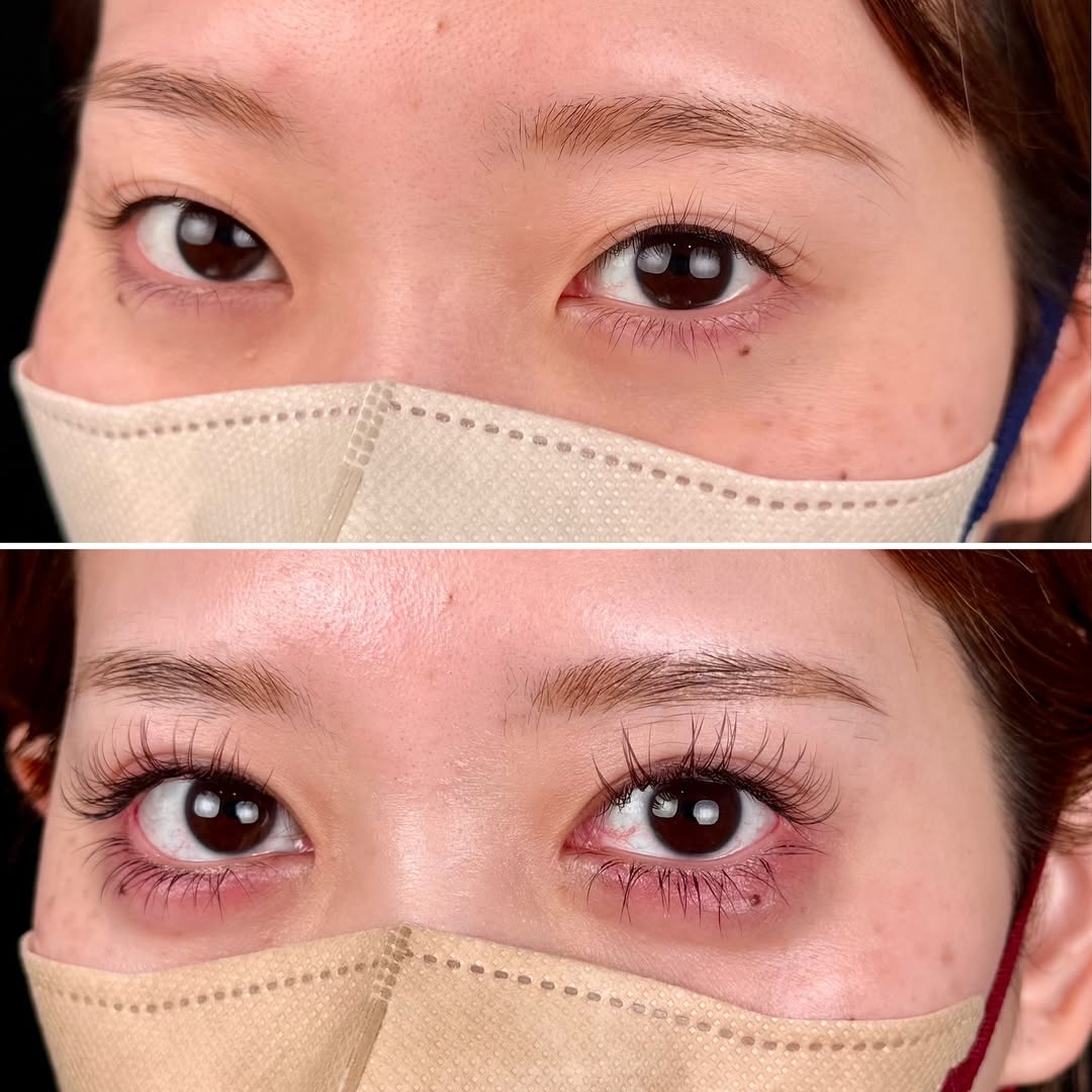 目元のフル整形 -目頭目尻切開,二重埋没,たれ目-のギャラリー画像