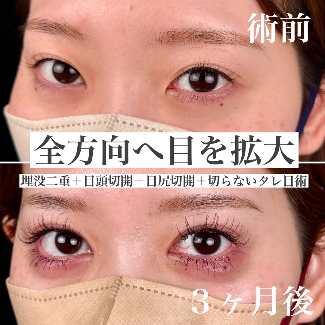 目元のフル整形 -目頭目尻切開,二重埋没,たれ目-の画像