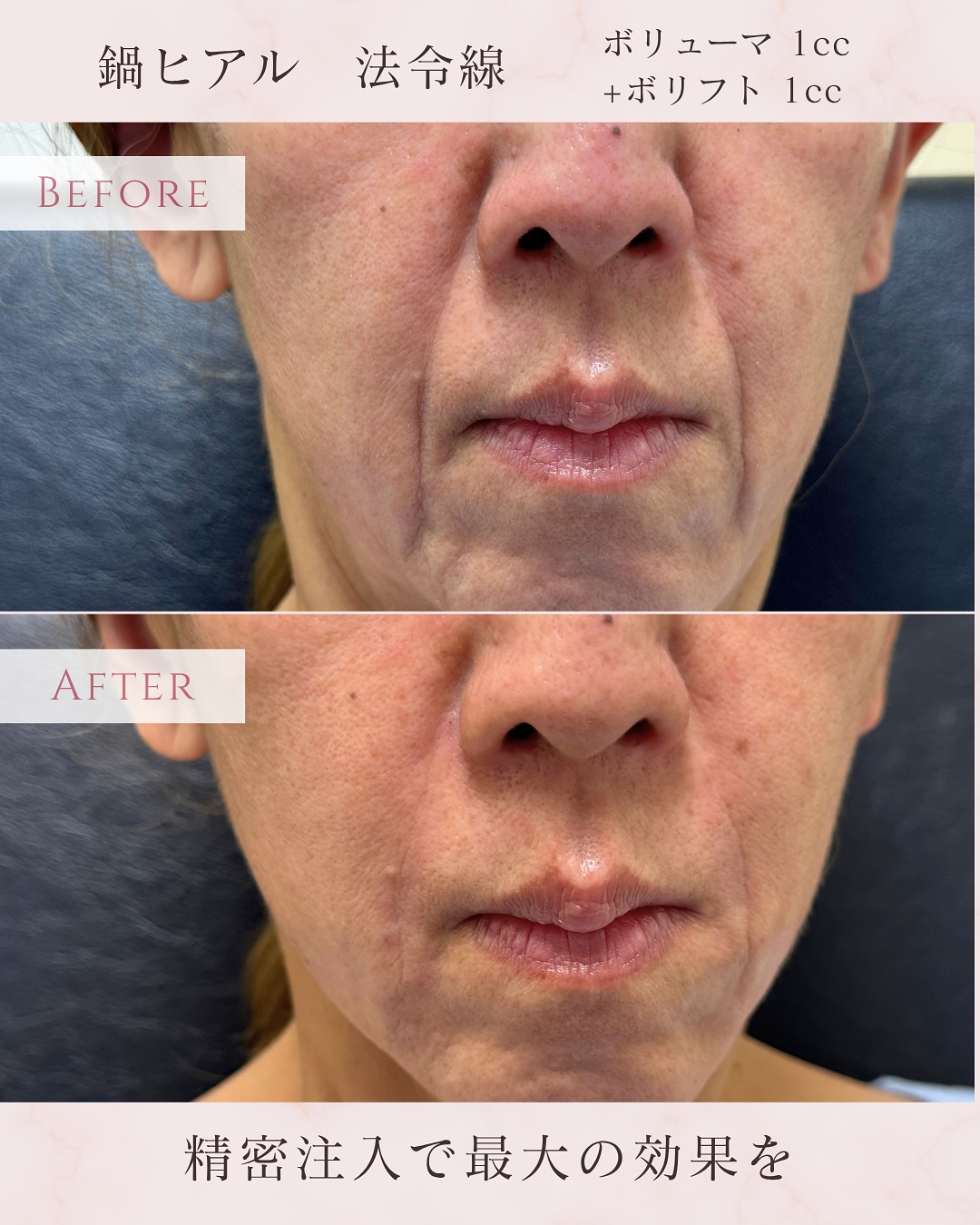 法令線ヒアルロン酸注入