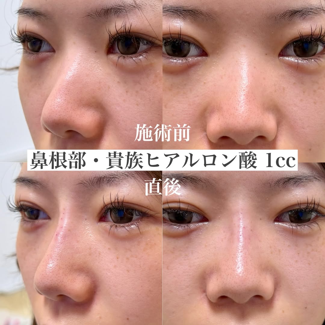 鼻根部と貴族部位へヒアルロン酸注入