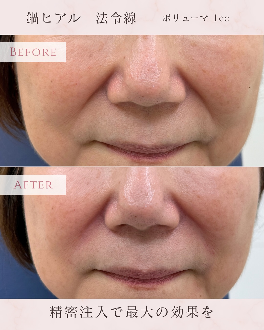 ヒアルロン酸注入 法令線へボリューマ1ccの画像