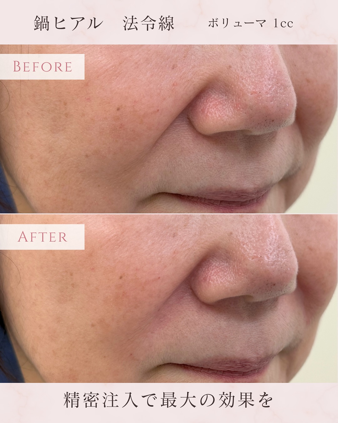 ヒアルロン酸注入 法令線へボリューマ1ccのギャラリー画像