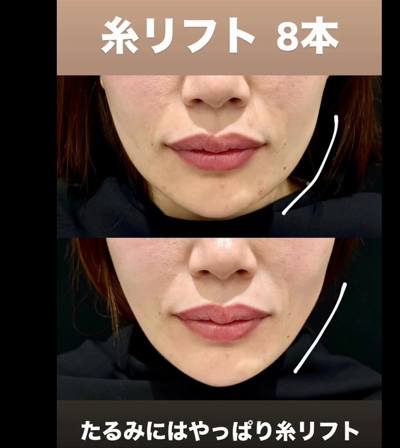 糸リフト症例集の画像