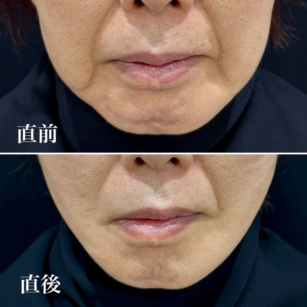 糸リフト症例（糸12本使用）の画像