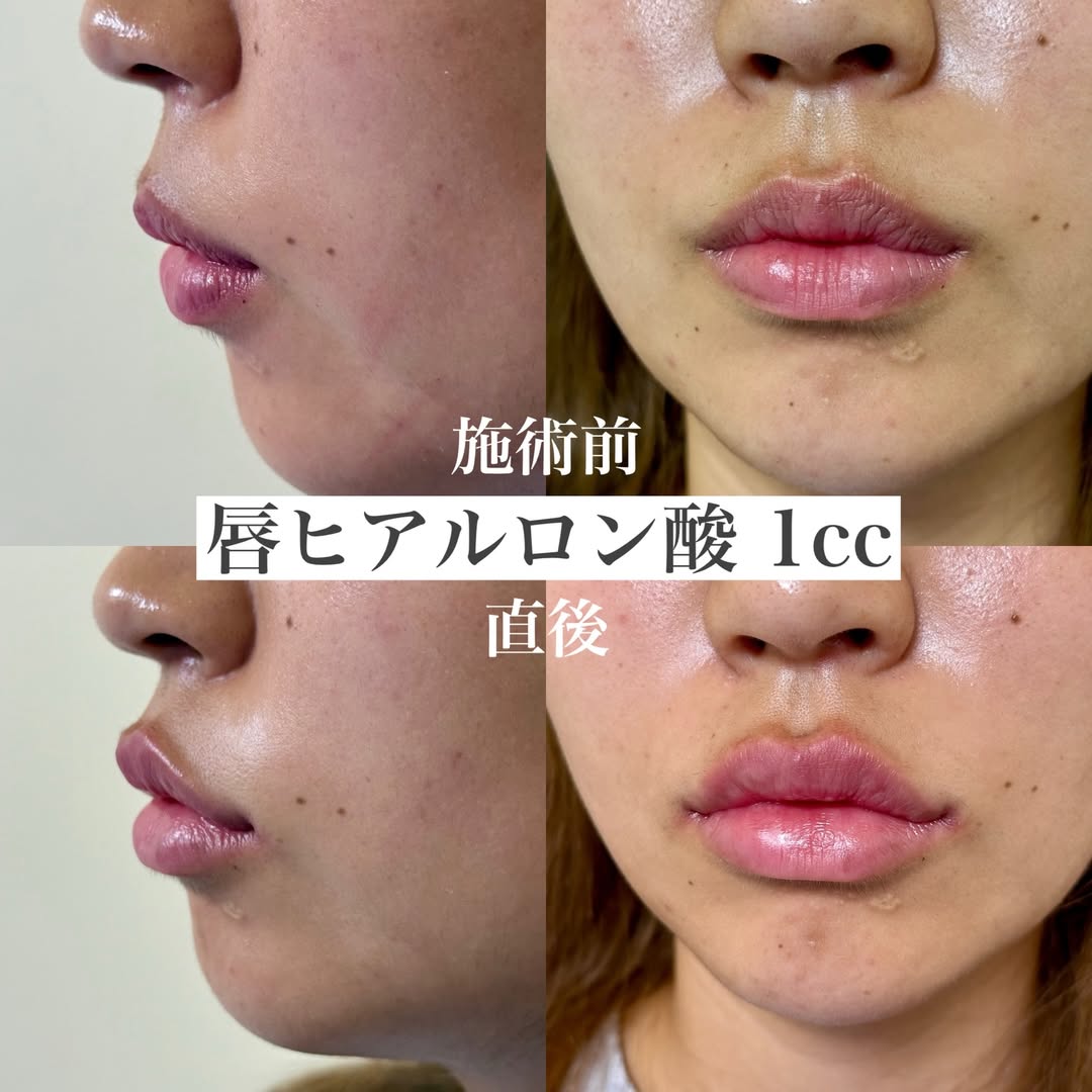 唇へヒアルロン酸の症例の画像