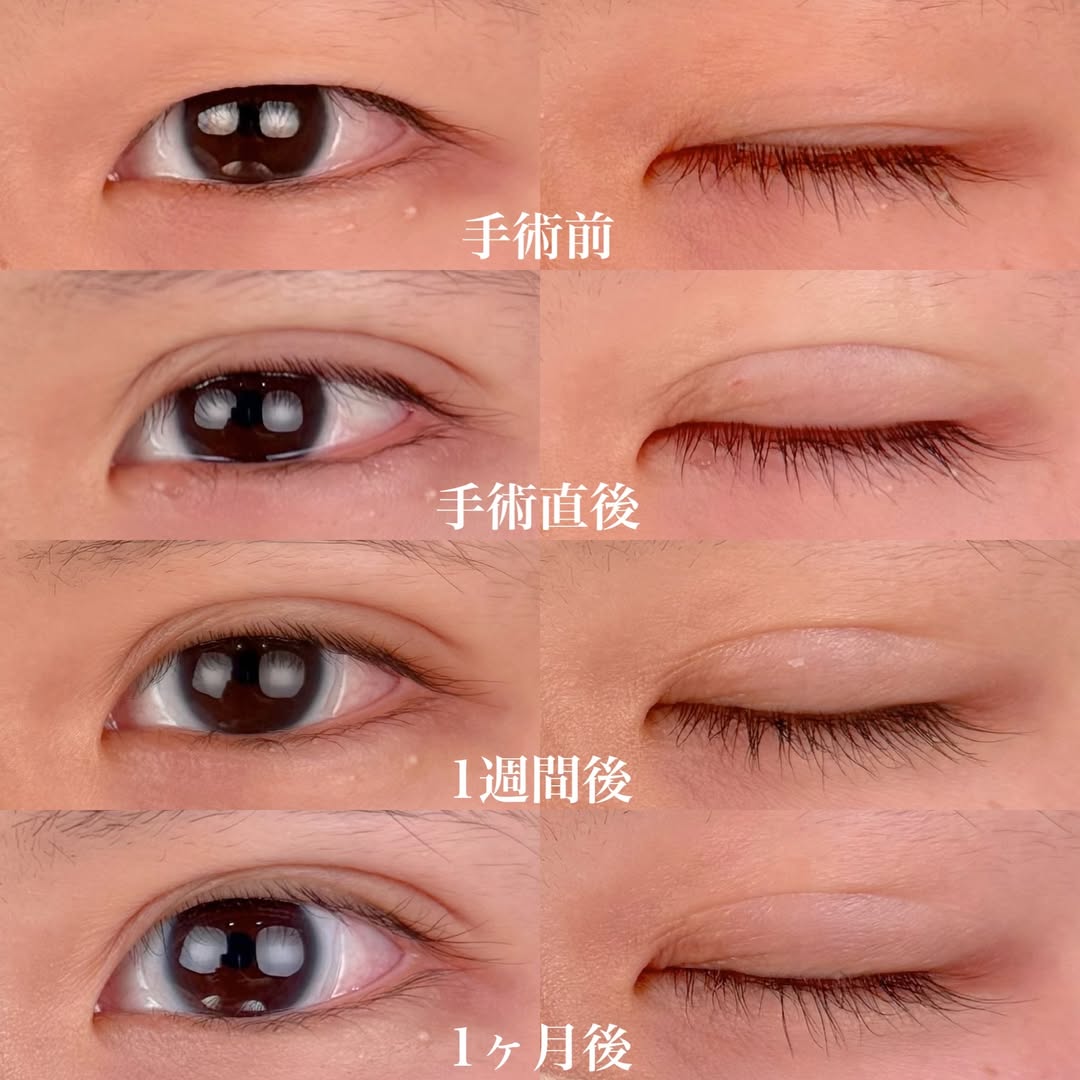 二重整形埋没法 経過症例の画像