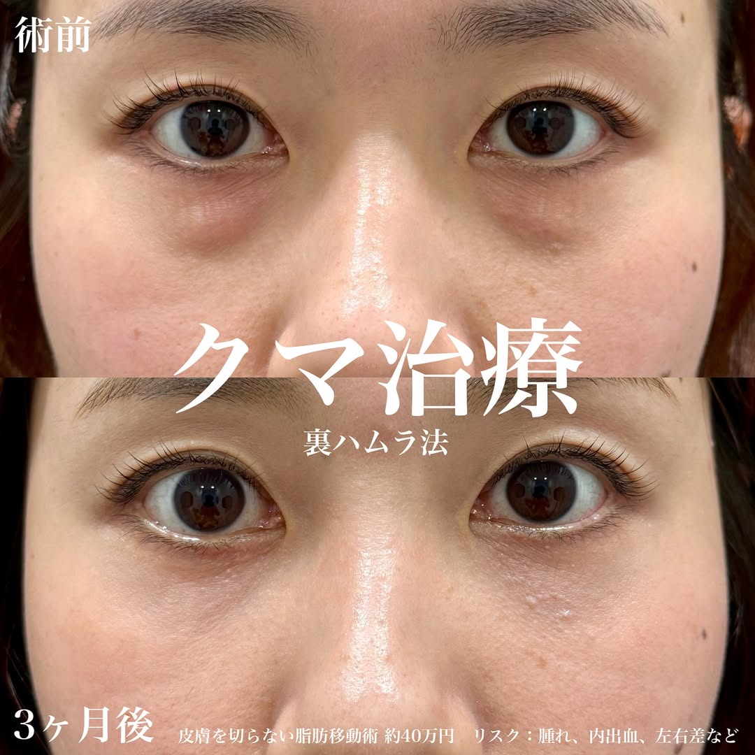 クマ取り治療 裏ハムラ法 症例～3ヶ月間の画像