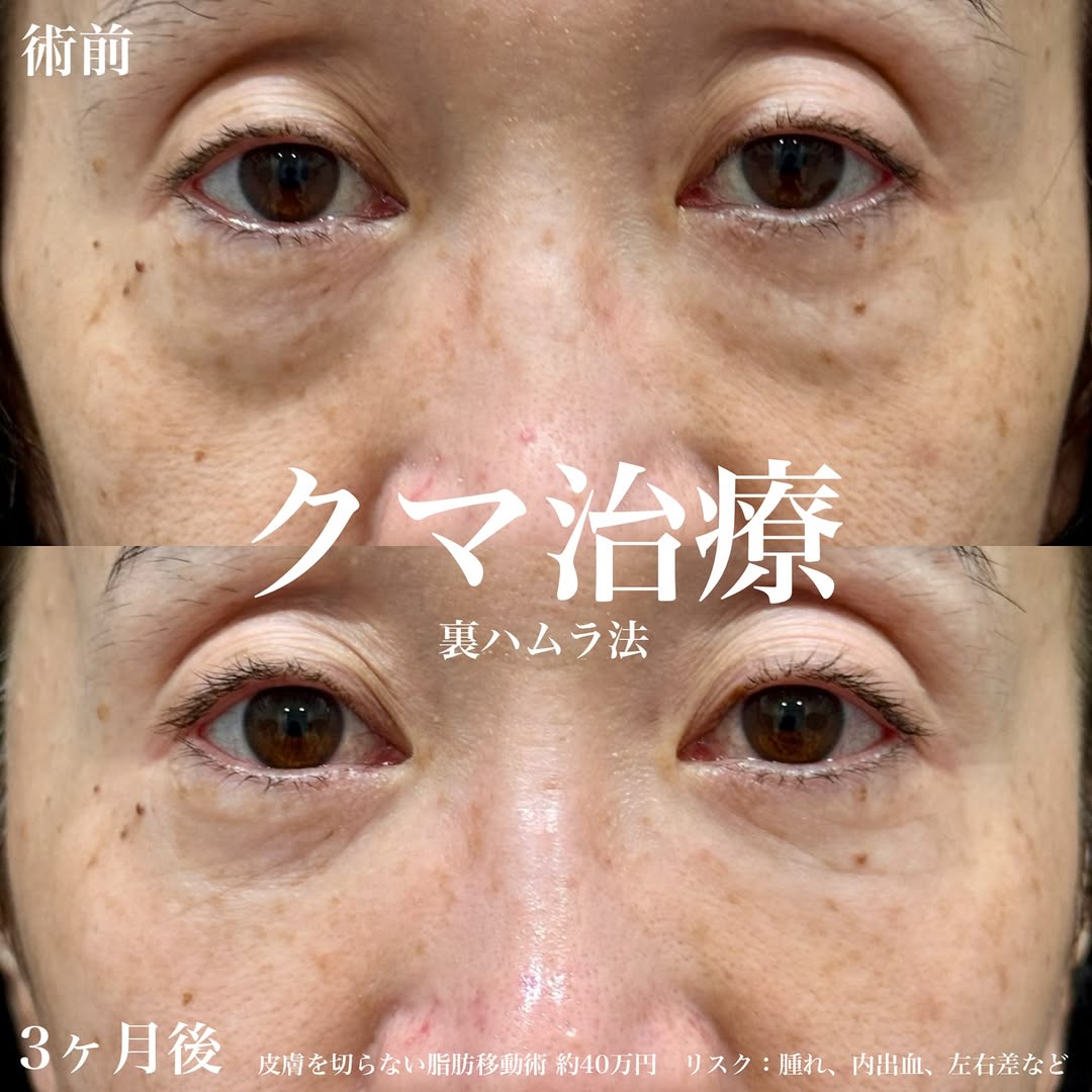 症例 裏ハムラ法の施術～3ヶ月後の画像