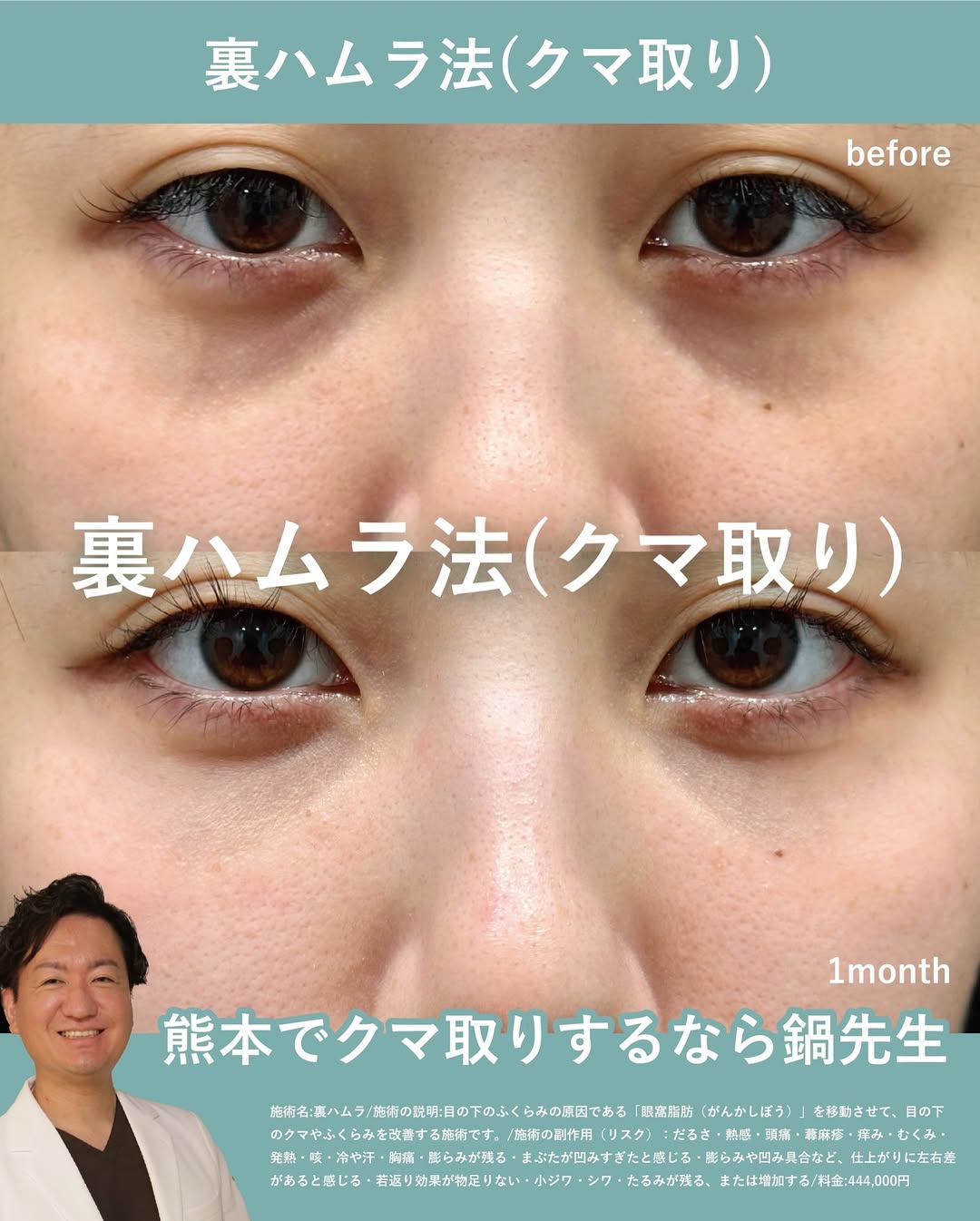 裏ハムラ法クマ取りの症例の画像