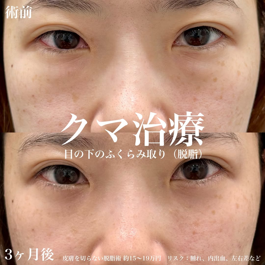 クマ取り治療の画像