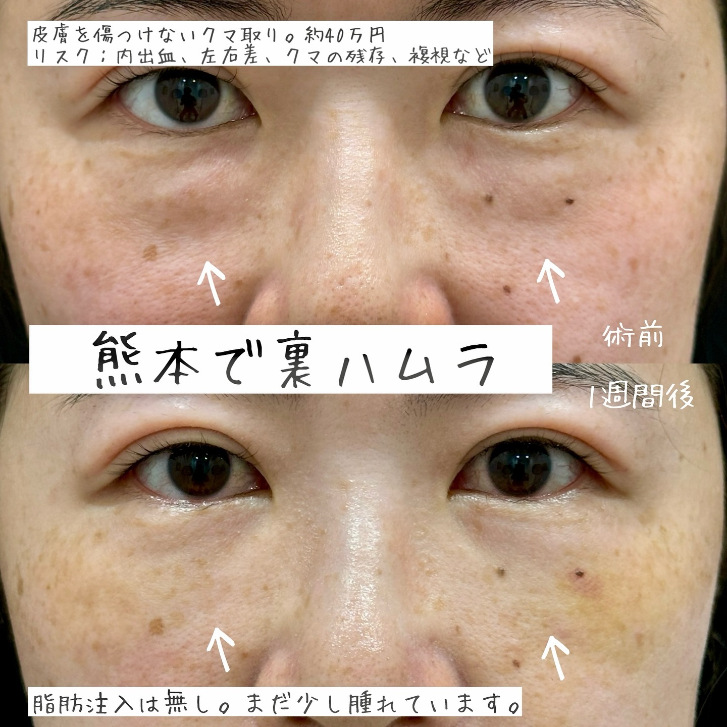 ふくらみのある強めのクマ取り症例