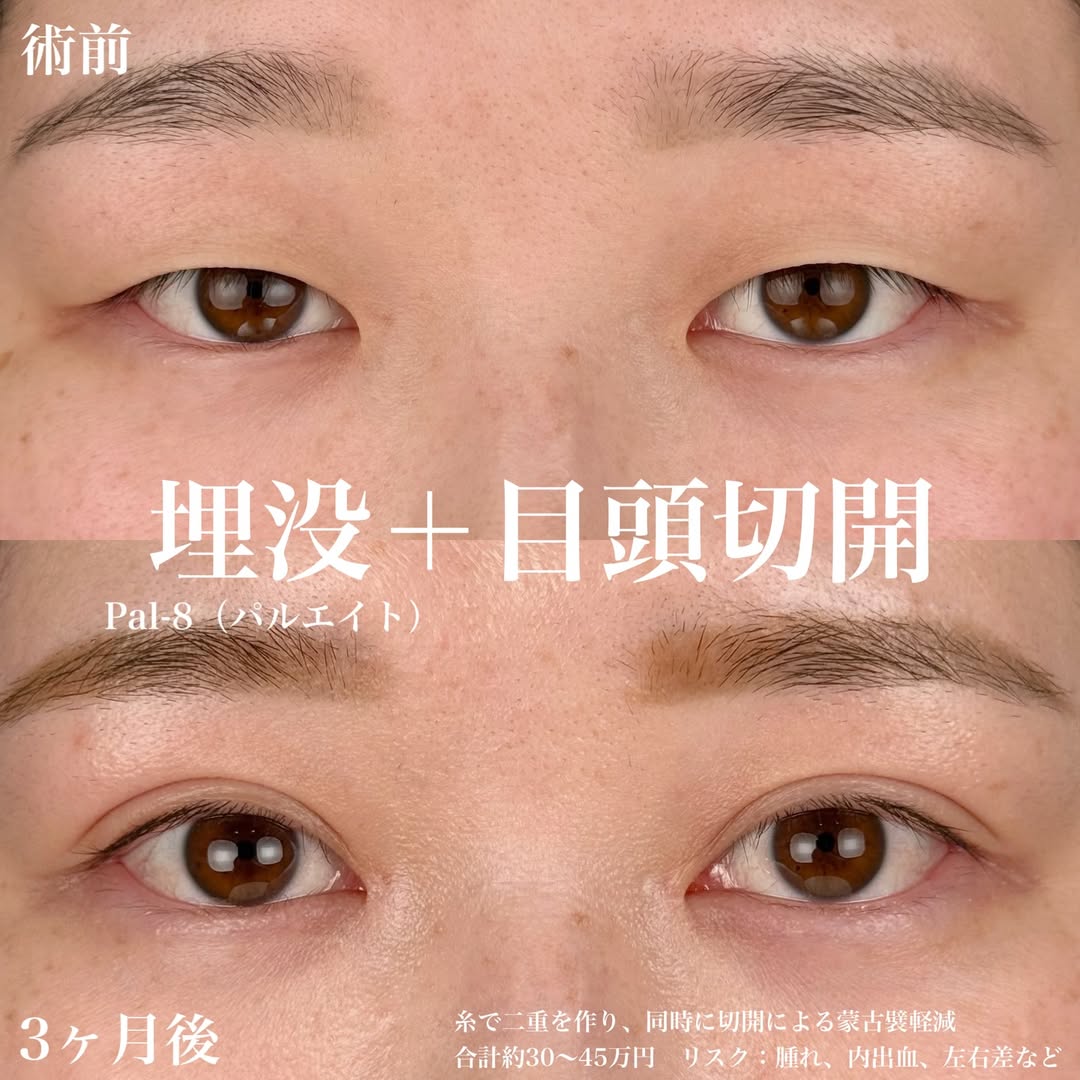 目頭切開と二重整形埋没法