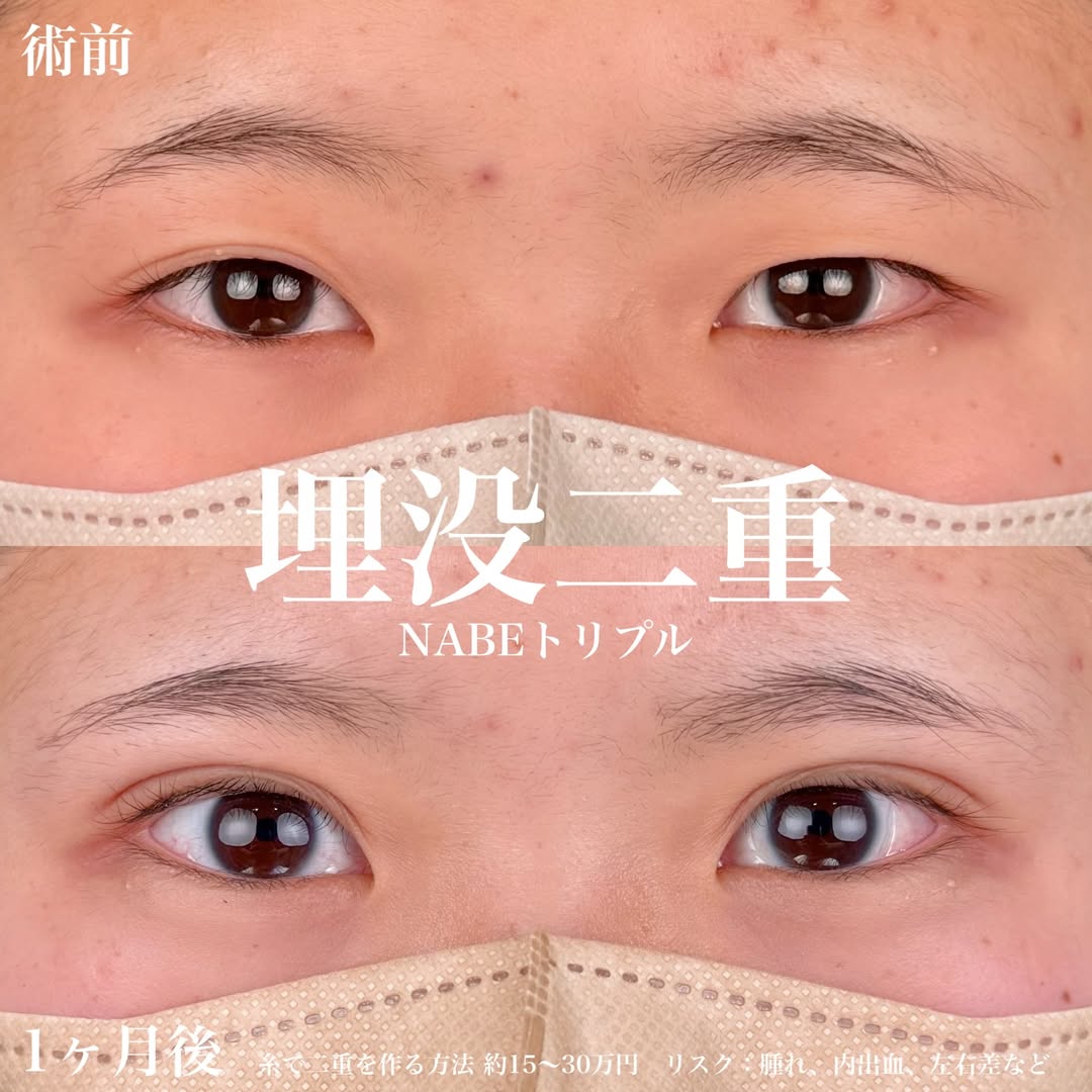 二重整形埋没法-NABEトリプル-