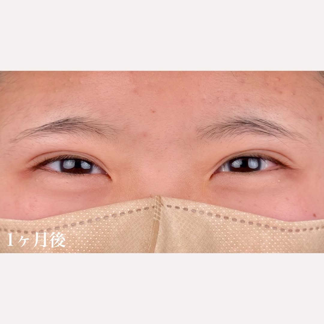 二重整形埋没法-NABEトリプル-のギャラリー画像