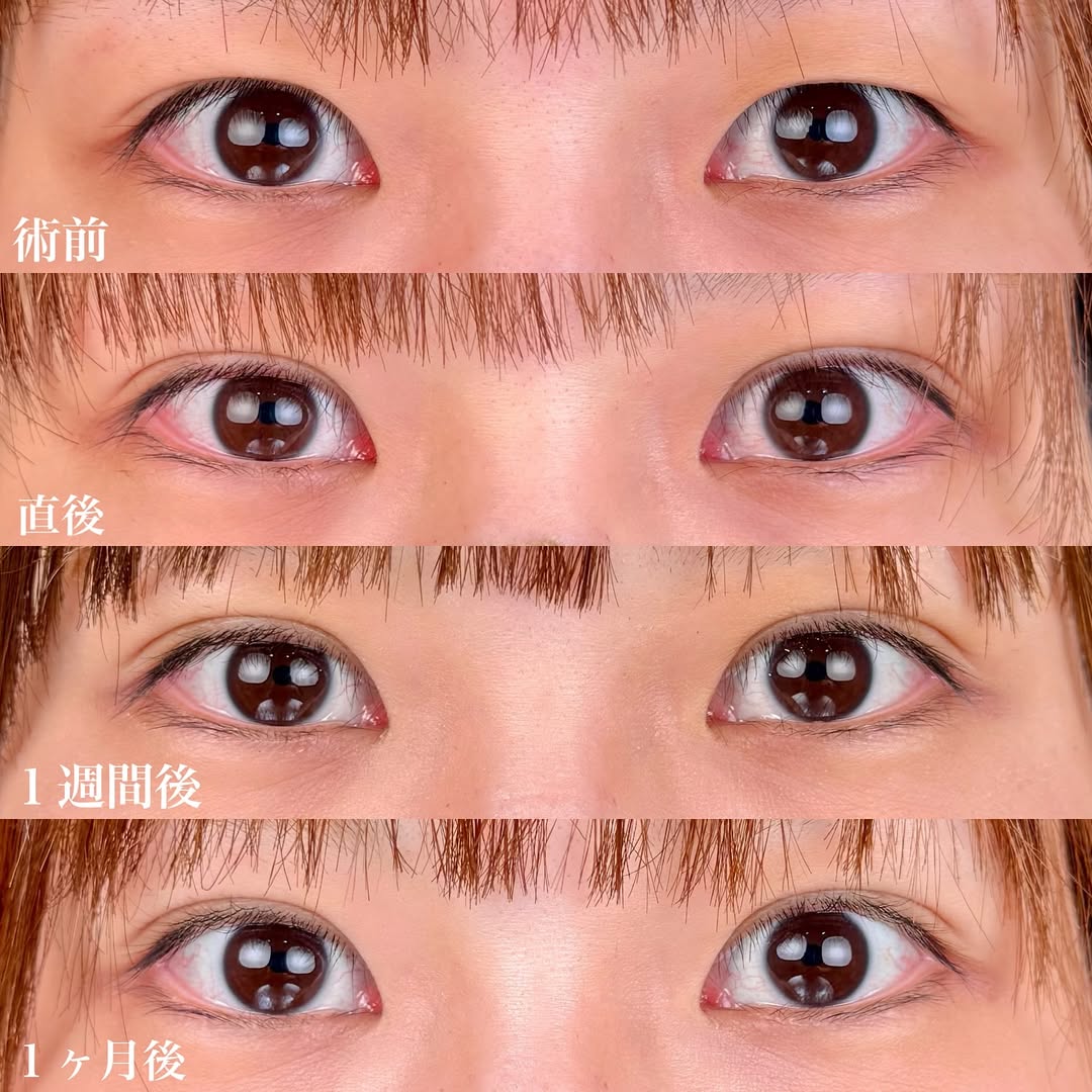 埋没法NABEダブル症例2