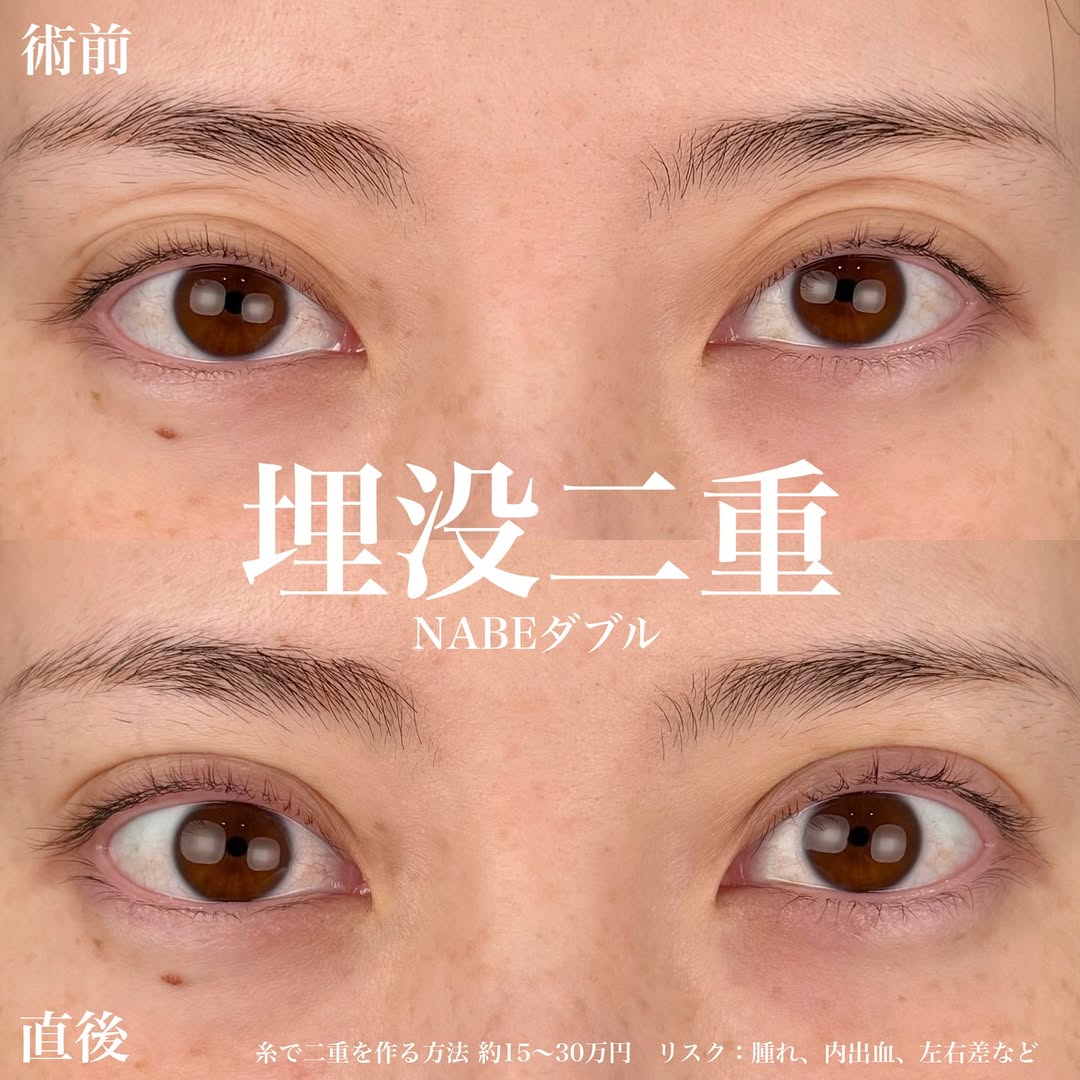 二重整形埋没法 NABEダブル～くっきり綺麗な二重に～
