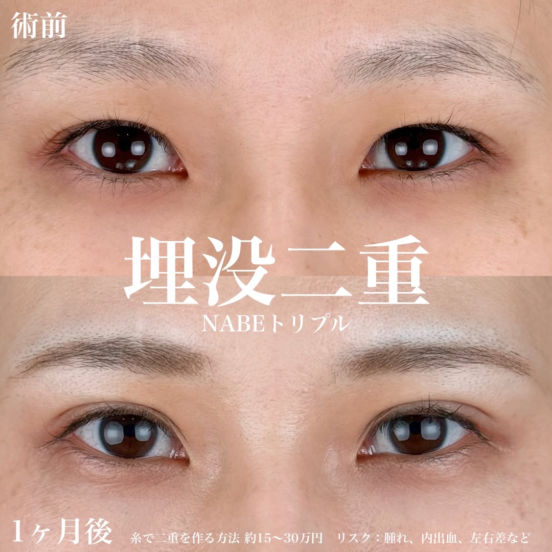 二重埋没法 バランスの良いmix型の画像