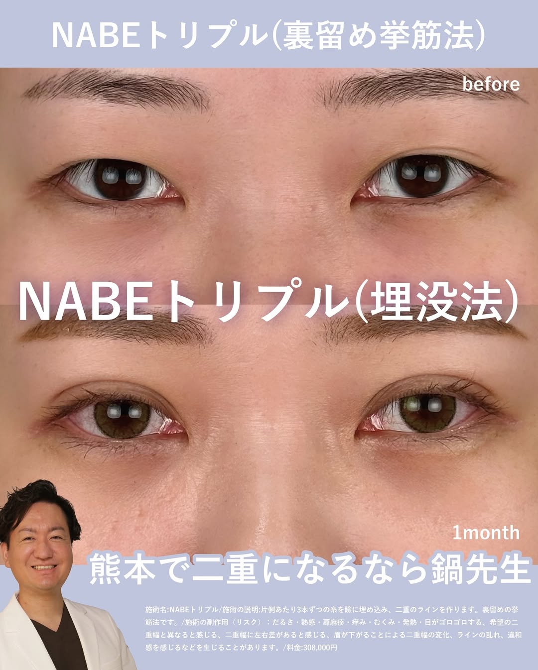 二重埋没法症例 目頭せまめの平行二重の画像