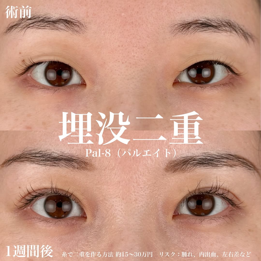 二重整形埋没法パルエイト症例の画像