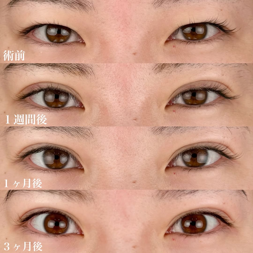 二重整形埋没法pal-8