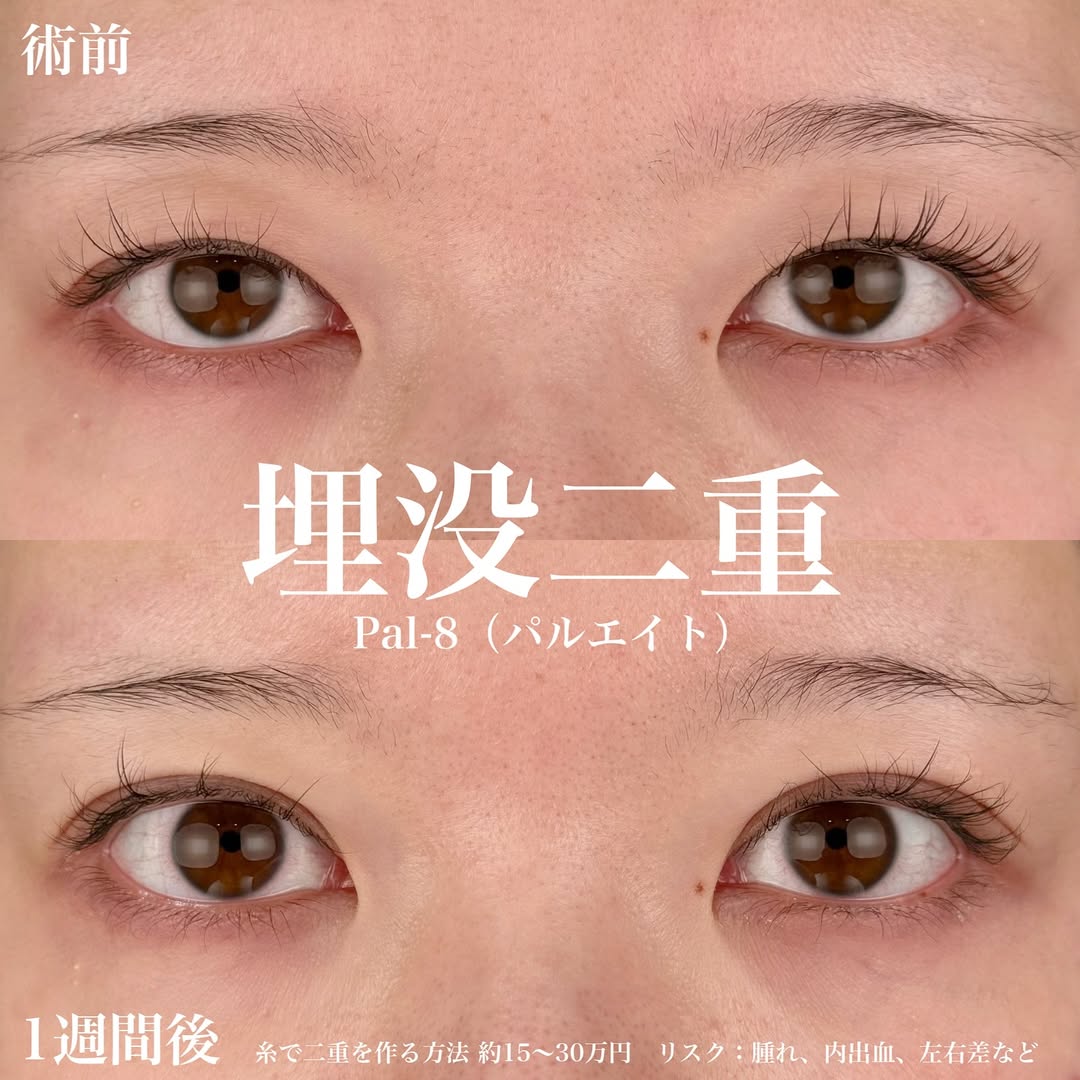 鍋医師独自の裏留め埋没法（パルエイト）症例の画像