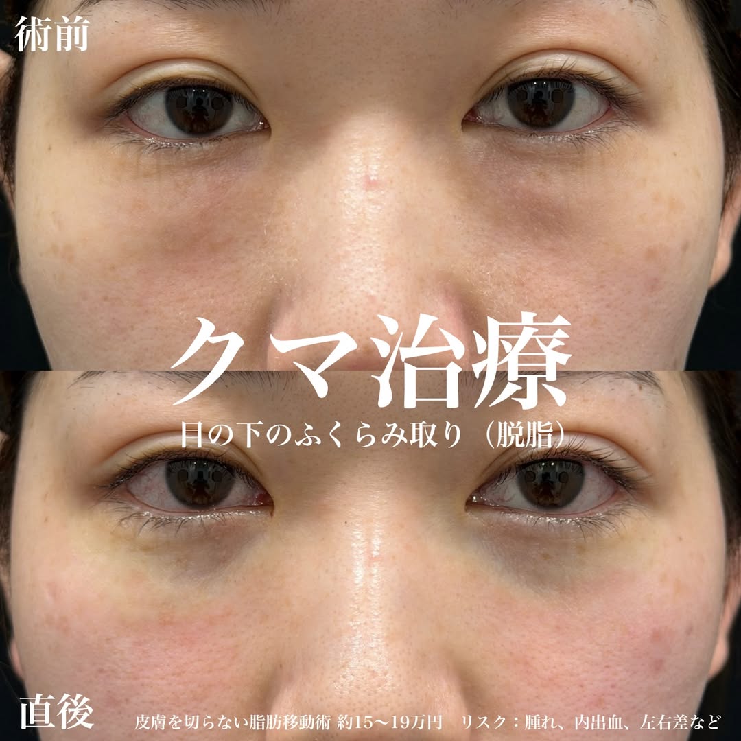 脱脂によるクマ取り治療の画像