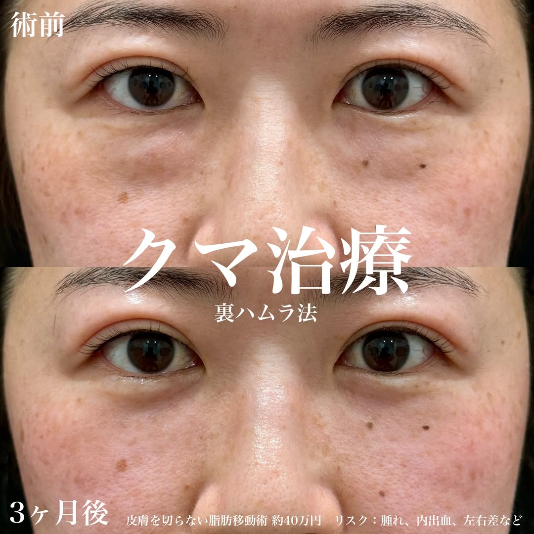 裏ハムラ法によるクマ取り 30代女性の画像