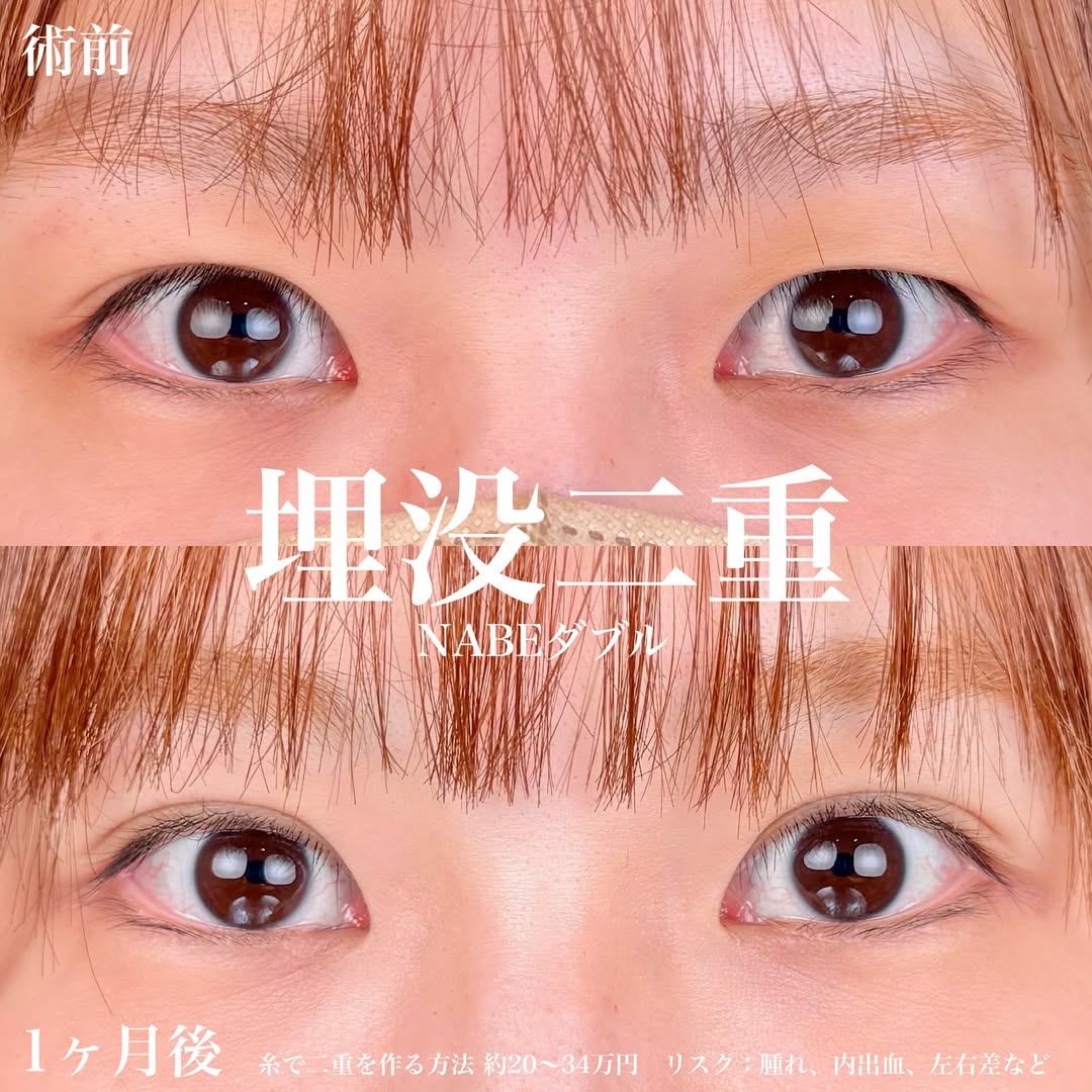 埋没法で瞼の左右差を改善