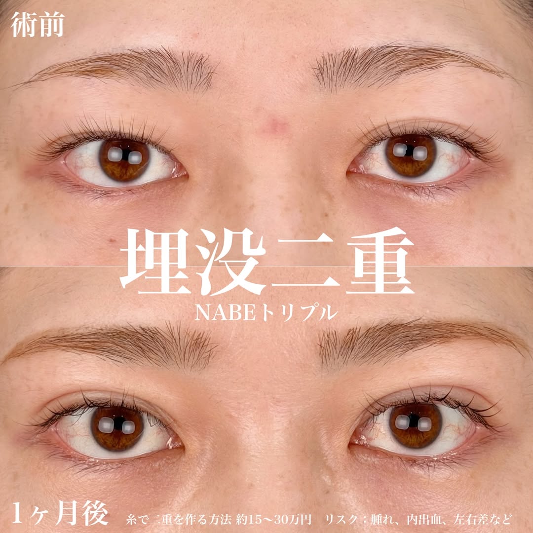 埋没法NABEトリプル経過1ヶ月