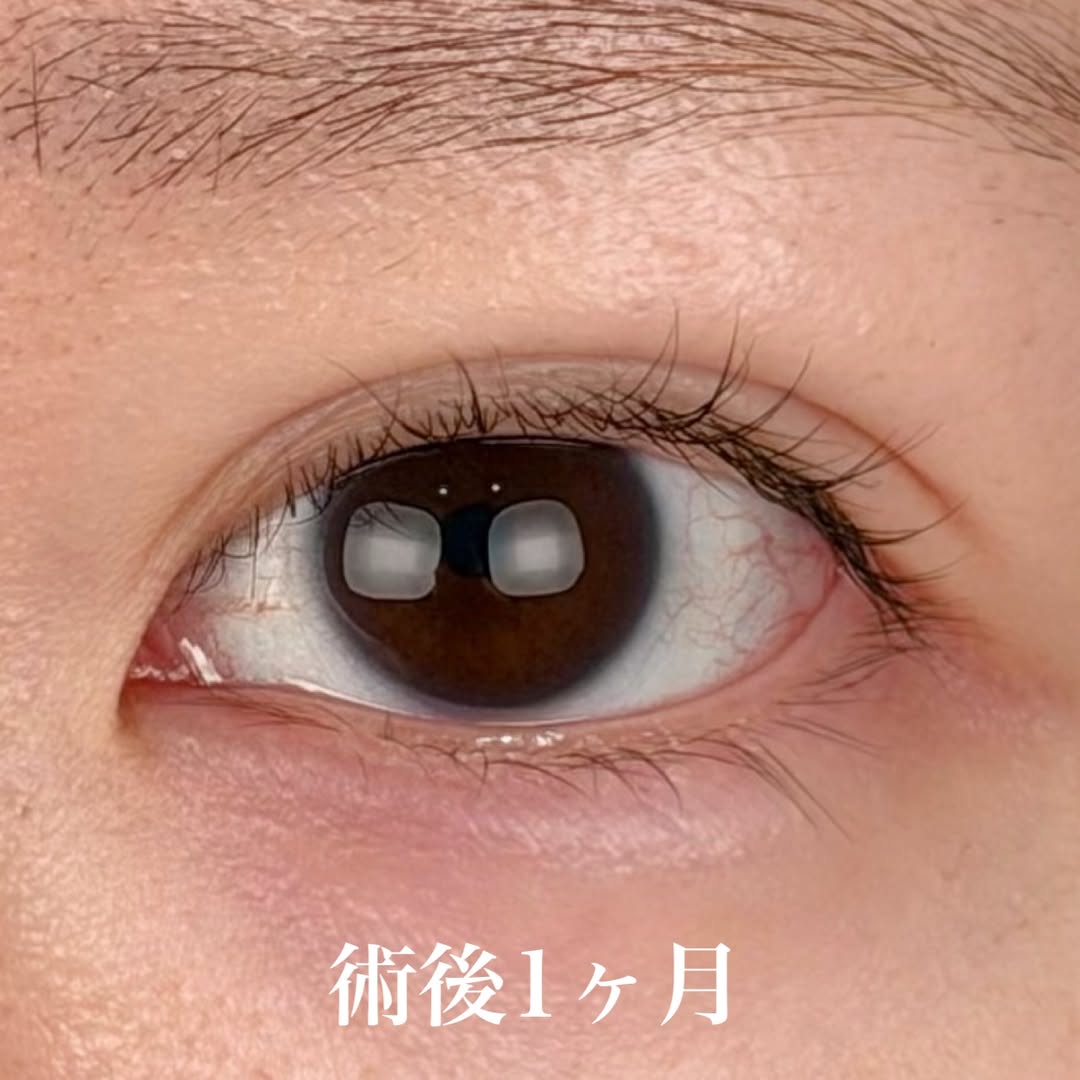 平行二重症例 -埋没法NABEトリプル-の画像