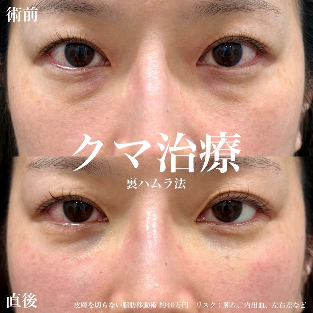 裏ハムラ法