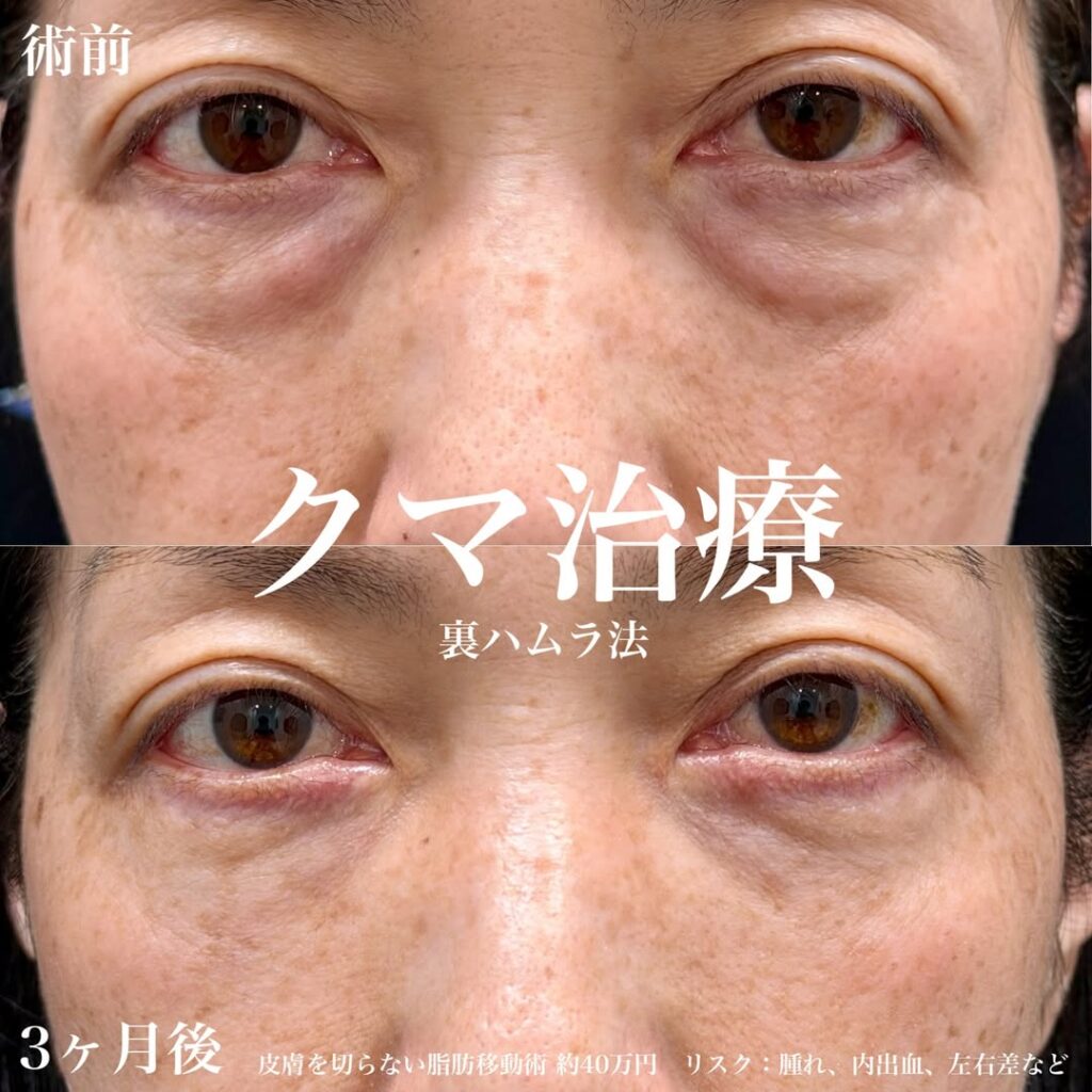 クマ取り治療