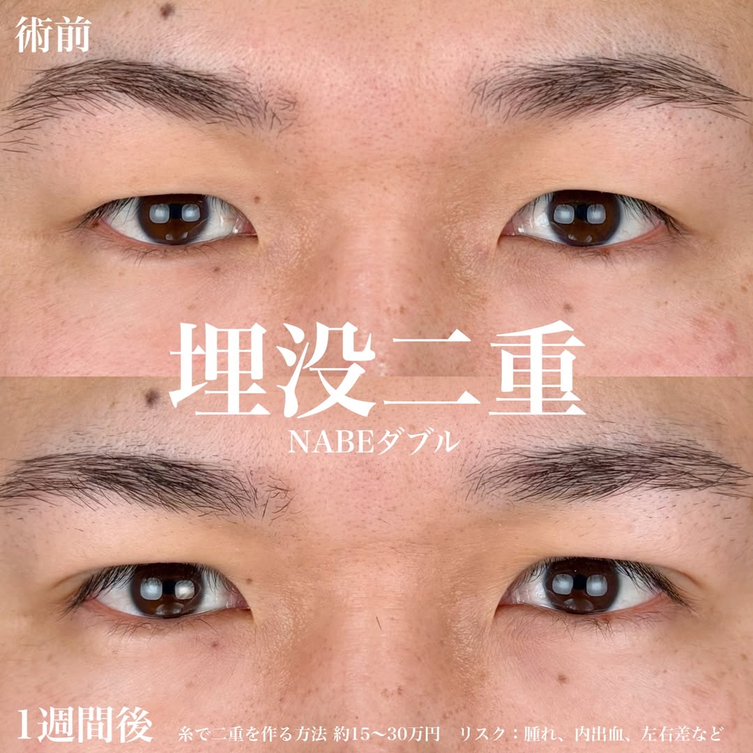 男性の二重整形埋没法 (メンズ二重)