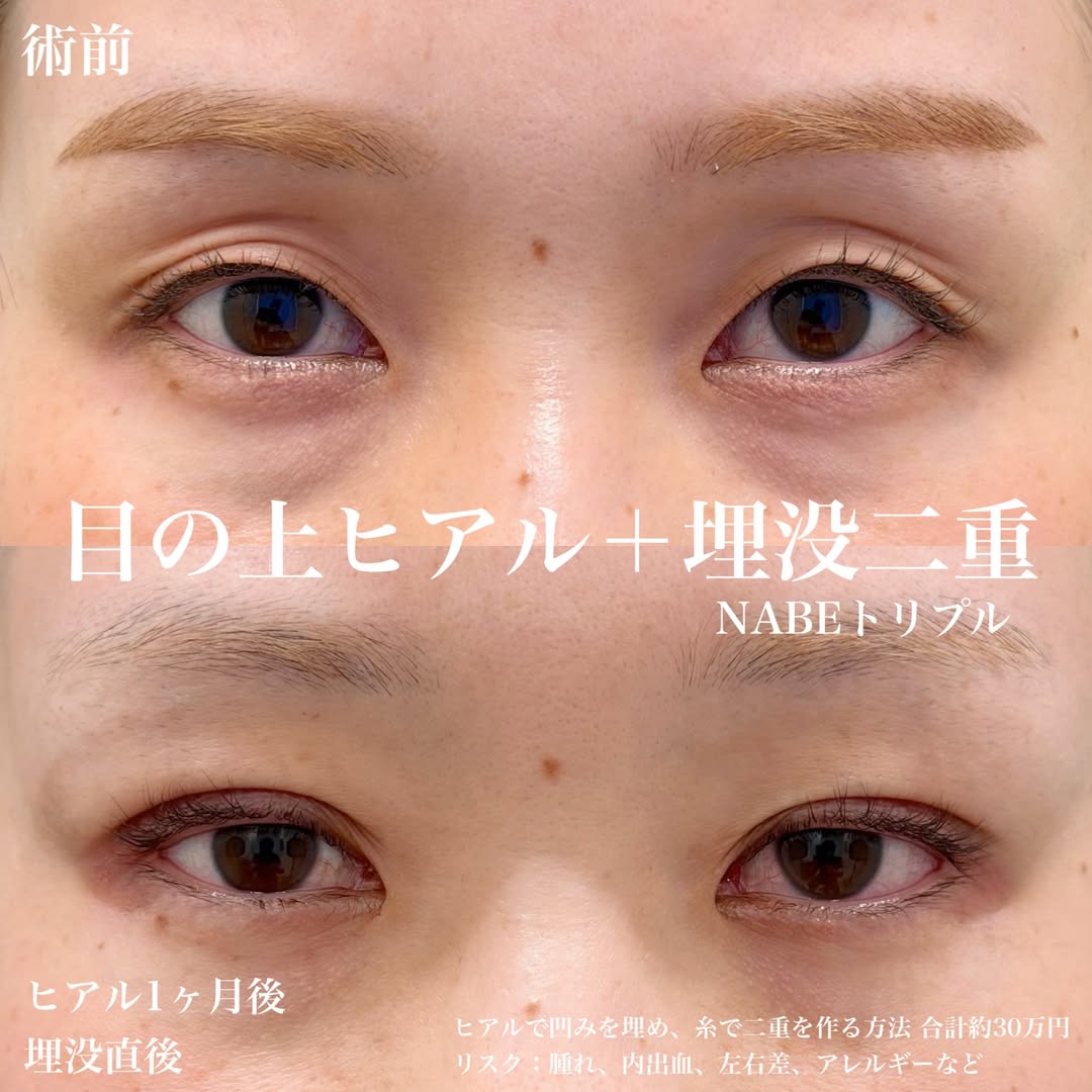 ヒアルロン酸注入＋埋没法（NABEトリプル）症例の画像