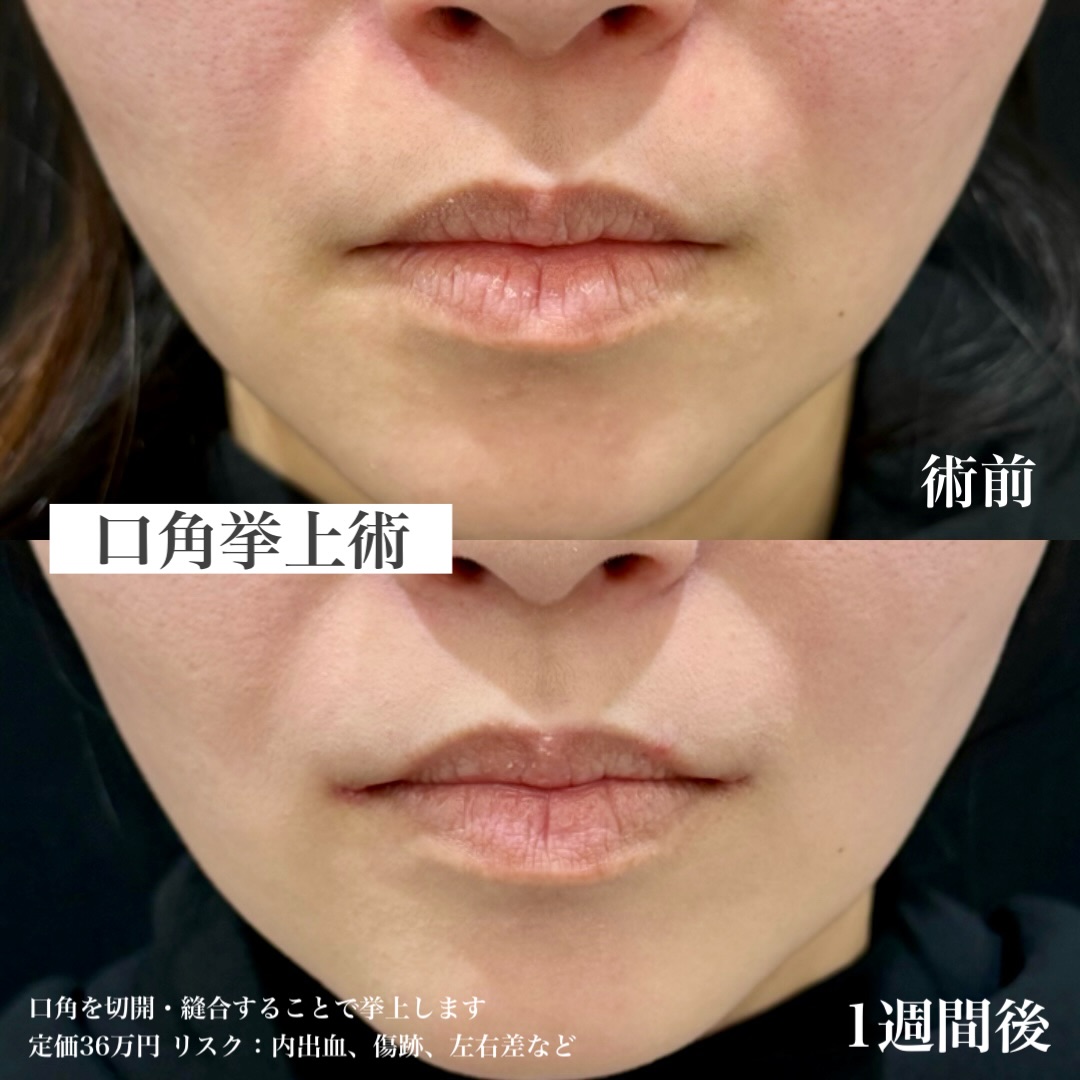 口角拳上で柔らかい表情にの画像