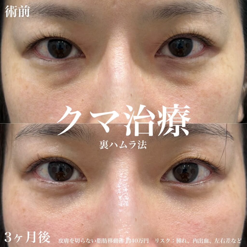 クマ取り治療