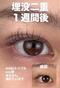 埋没法NABEトリプル症例 MIX型二重への画像