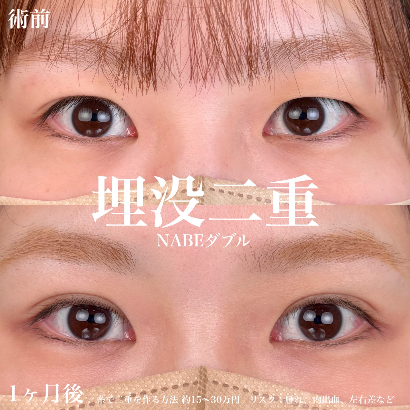左右揃ったナチュラルな末広二重にの画像