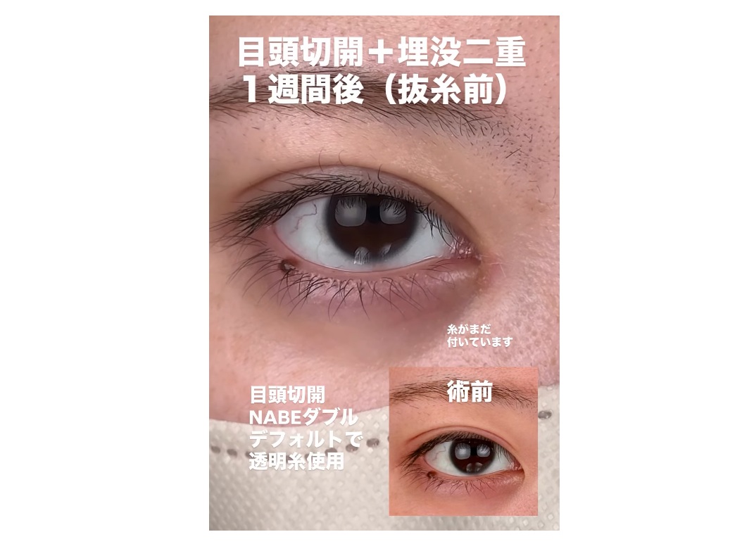 NABEダブル埋没法でまつ毛のキワの見えるmix型にの画像