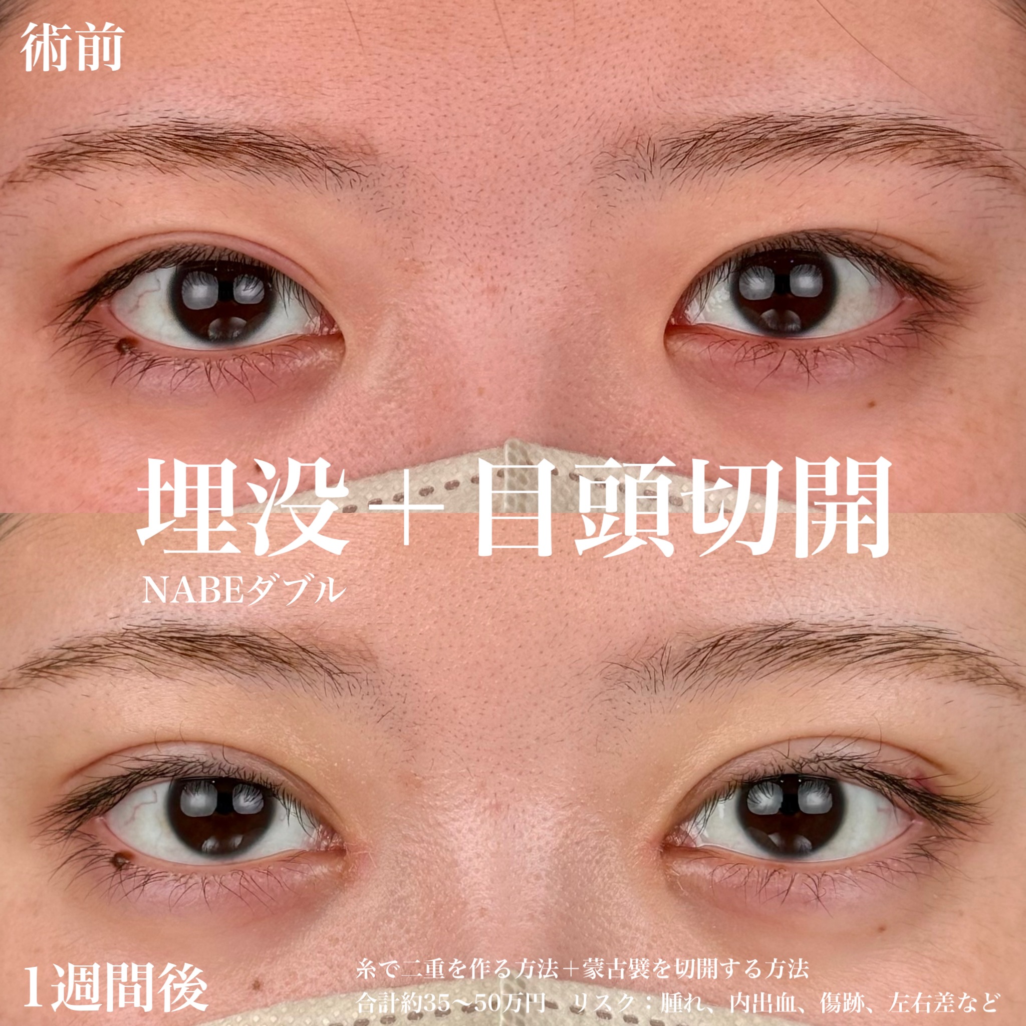 目頭切開＋二重整形埋没法でスッキリした印象にの画像